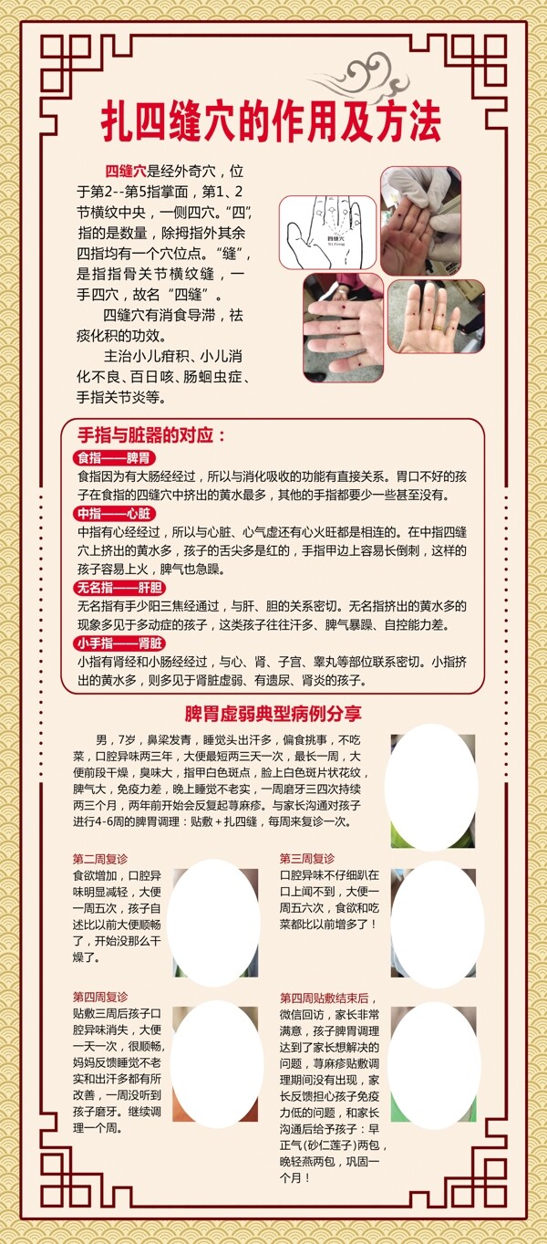 中醫(yī)扎四縫圖片
