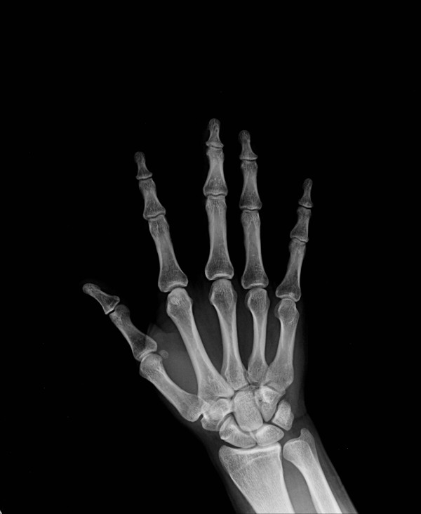 手掌关节X光片图片