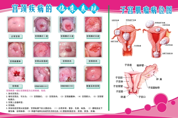 子宮肌瘤圖圖片