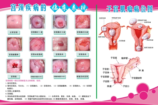 子宫肌瘤图图片